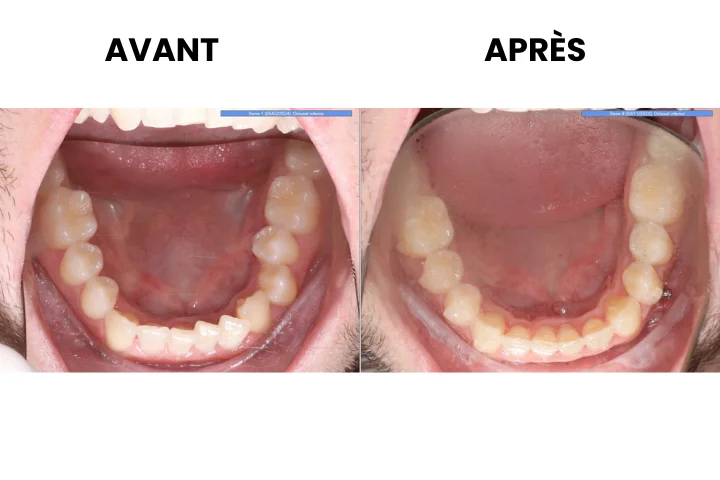 avant apres invisalign